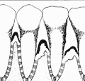 Periodontal Gum Disease