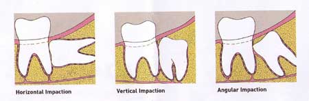 Wisdom teeth extractions